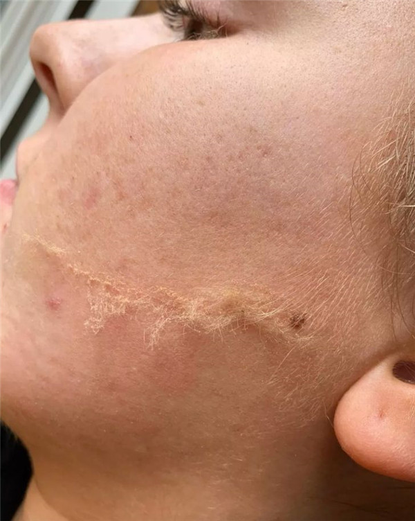 除了拍照磨皮还不够，欧美女生迷上了人工磨皮