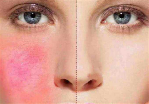 激素脸有什么危害，激素脸怎么缓解