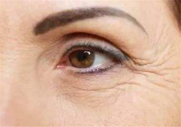 下垂眼有几种，怎么提升