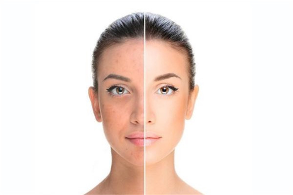 油性皮肤适合什么类型的隔离