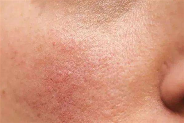 敏感性皮肤怎么改善，敏感性皮肤怎么护理