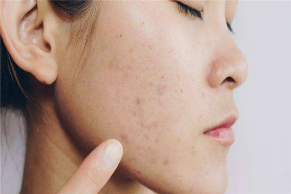 油痘肌适合什么水乳，油痘肌适合什么牌子的水乳