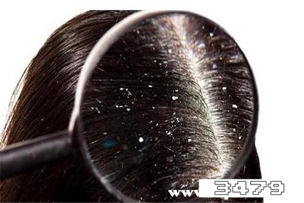 治头皮屑最好的洗发水，头皮干燥头屑多用什么洗发水有效