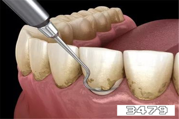 去除牙结石最有效的牙膏，牙黄牙结石用什么牌子牙膏好