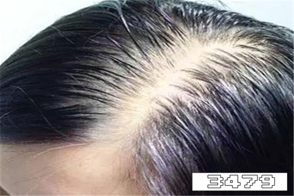 脂溢性脱发用碱性还是酸性，脂溢性脱发用什么洗发水