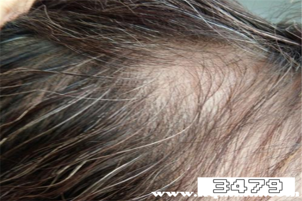 白发转黑发哪个品牌有效，白发转黑发靠谱吗