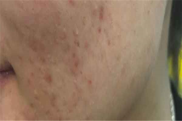 痘印脸和橘皮脸的区别