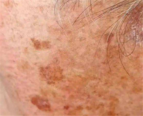 消除老年斑要注意些什么