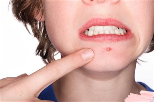 戴口罩下巴长痘痘怎么办，戴口罩长痘痘是什么原因