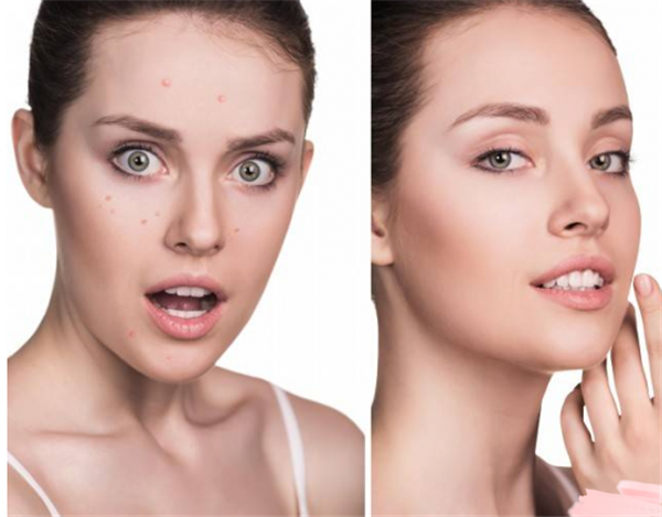 戴口罩长痘痘涂什么药膏，关于戴口罩小贴士