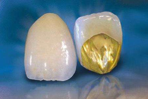 烤瓷牙掉了怎么办可以粘回去吗，烤瓷牙掉了多久之内必须粘回去