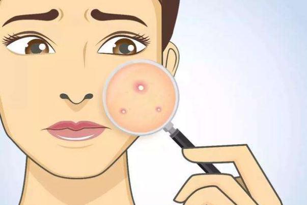 痘痘肌肤会不会遗传，痘痘肌肤会自动修复吗