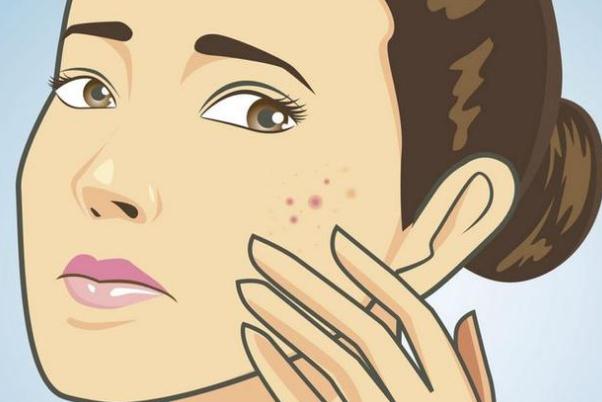 痘痘肌肤有哪几种类型，痘痘肌肤有什么特征