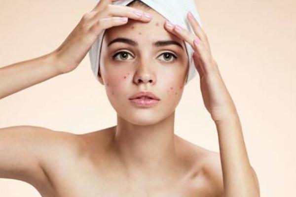 痘痘肌肤适合用什么面霜，痘痘肌的形成原因