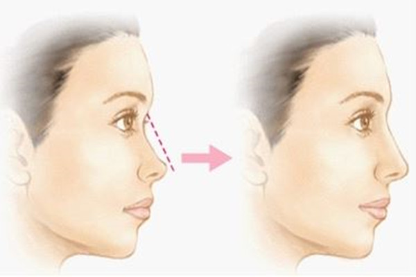 隆鼻要忌口多久，隆鼻可以喝咖啡吗