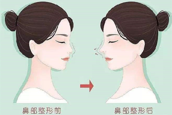 隆鼻有风险吗，隆鼻有积液是不是感染了