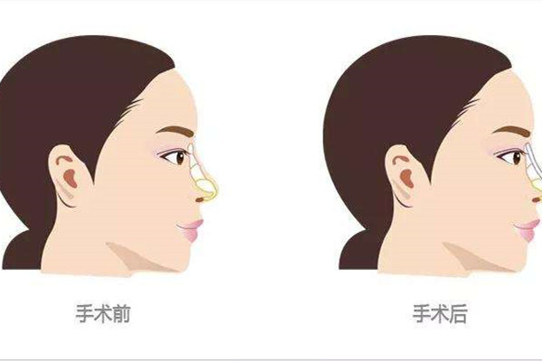 隆鼻后后遗症有哪些呢，隆鼻手术后注意事项