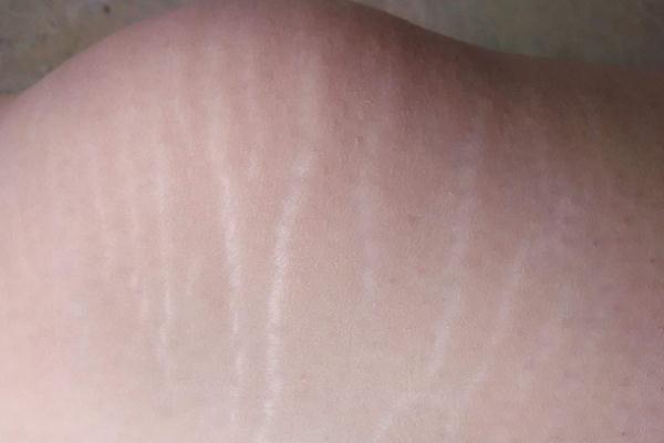 肥胖纹要注意什么，肥胖纹有什么影响吗