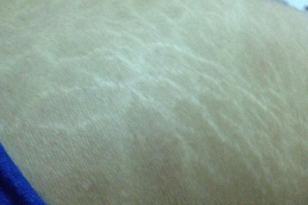 肥胖纹是横的还是竖的，肥胖纹要多久才能完全消除吗