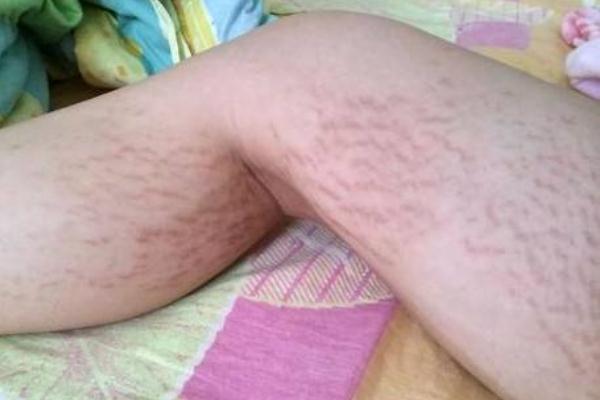 肥胖纹会自动消失吗，肥胖纹的形成