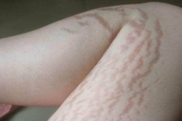 肥胖纹怎么去掉，肥胖纹红色和白色哪个更严重