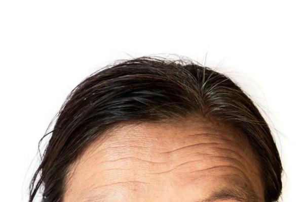 抬头纹是天生的吗还是后天的，抬头纹是遗传的吗