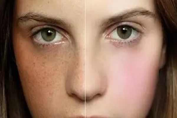 玫瑰花能去除黄褐斑吗，蜂王浆能去除黄褐斑吗