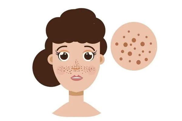 黄褐斑属于真皮斑吗，黄褐斑跟真皮斑的区别