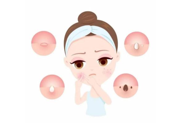 青春痘有哪几种类型，青春痘有脓包怎么办