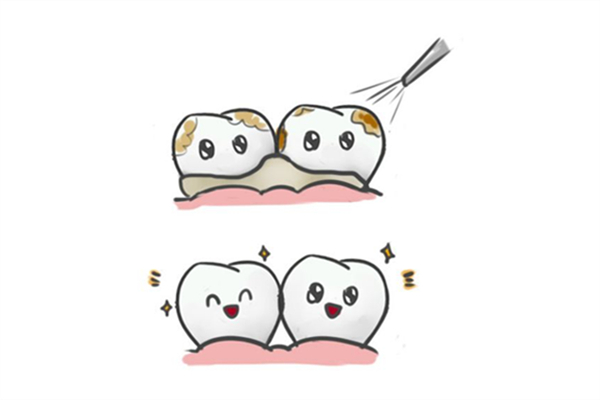 洗牙后牙齿缝隙变大怎么办，洗牙后牙缝大怎么修补