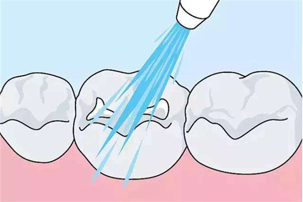 洗牙是挂什么科，洗牙用什么洗的干净