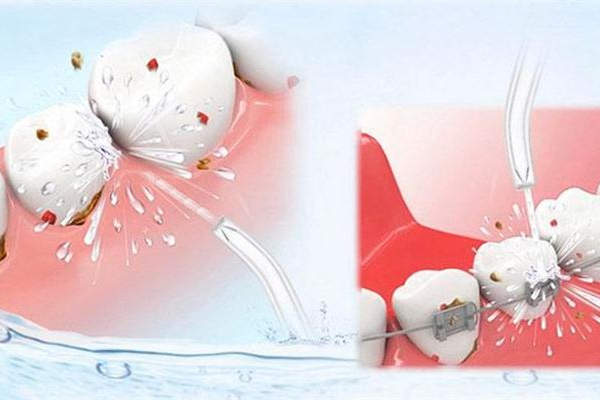 洗牙会造成牙齿松动吗，洗牙会损害牙齿吗