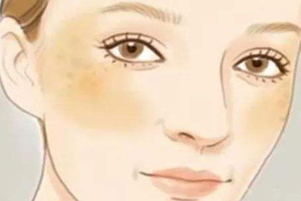 晒斑是什么样子的，晒斑是因为防晒没做好吗