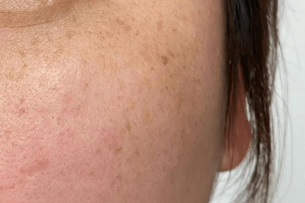 晒斑怎么去除掉，晒斑能彻底根除吗