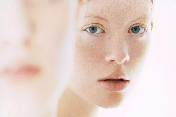 晒斑是黄褐斑的一种吗，晒斑是老年斑吗