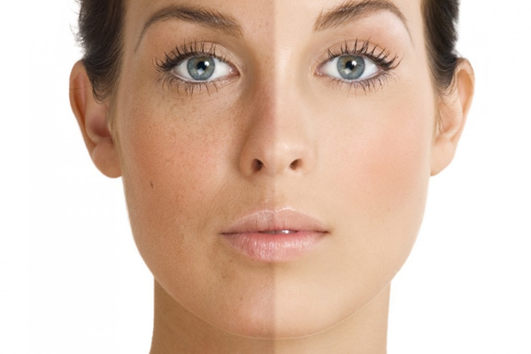 晒斑是什么，晒斑是如何形成的