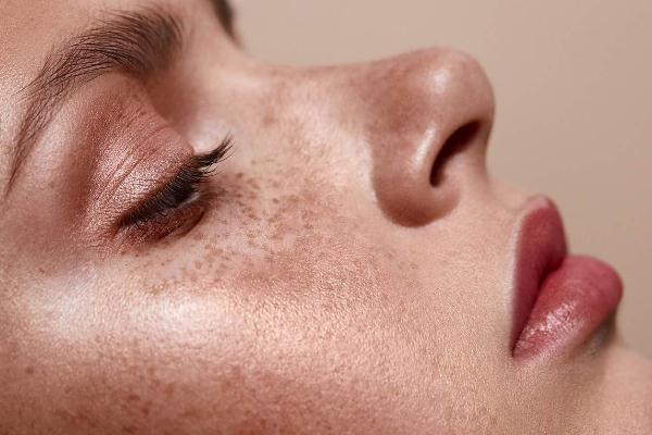 雀斑去除的最佳方法，雀斑能不能彻底根除