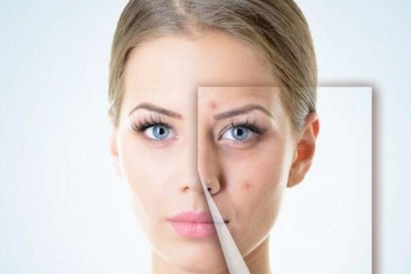 点痣留下的凹陷坑怎么修复，点痣多久可以恢复正常护肤