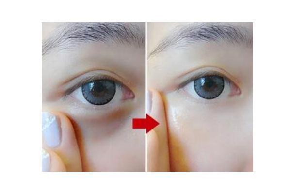 黑眼圈能自己消除吗，黑眼圈手术一般多少钱