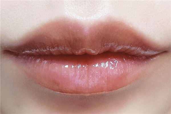 丰唇需要打几支玻尿酸，丰唇需要打麻药吗