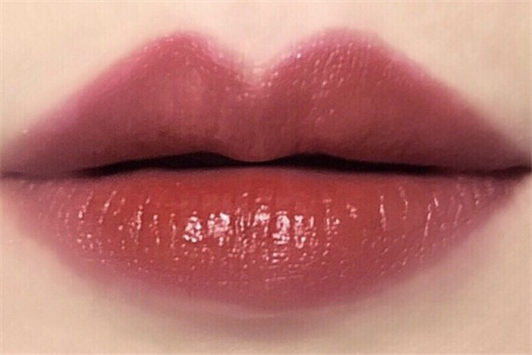 丰唇会使人中变短吗，丰唇后有淤青正常吗