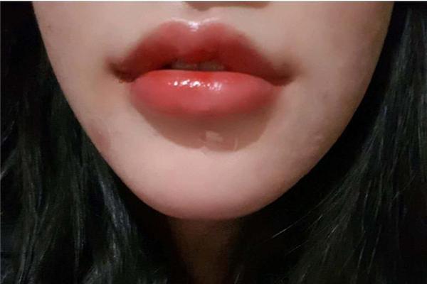 丰唇有多疼，丰唇要注意什么