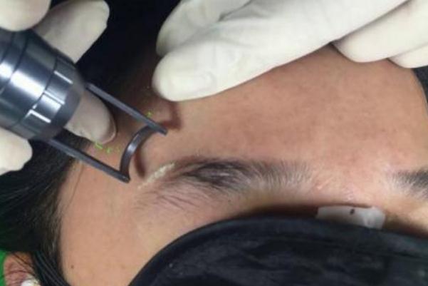 激光洗眉会留下疤痕吗，激光洗眉一般需要多少钱