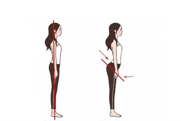 骨盆前倾有必要矫正吗，骨盆前倾对身体的危害