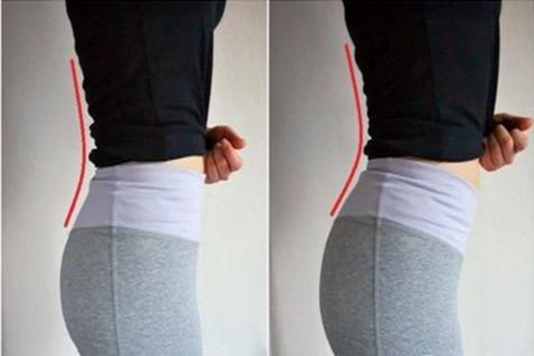 骨盆前倾可以通过正骨恢复吗，骨盆前倾去哪里矫正