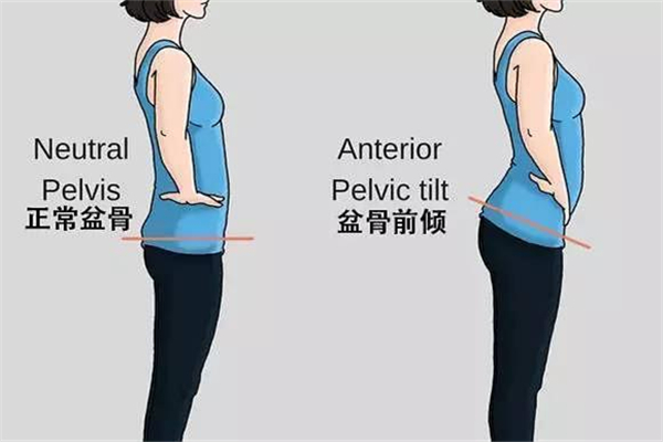 骨盆前倾能矫正过来吗，骨盆前倾最快纠正法