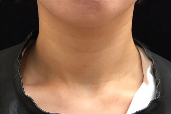 颈纹跟年龄有关系吗，颈纹一般多大年龄会出现