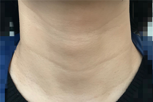 颈纹去除术可以维持多久，颈纹去除术是永久的吗