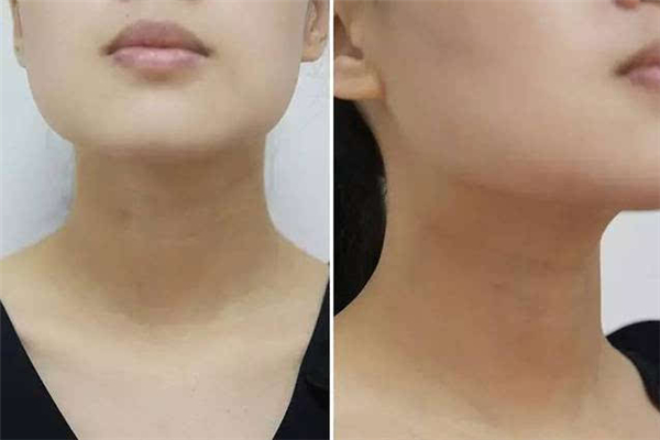 颈纹和胖瘦有关系吗，颈纹是因为胖才有的吗