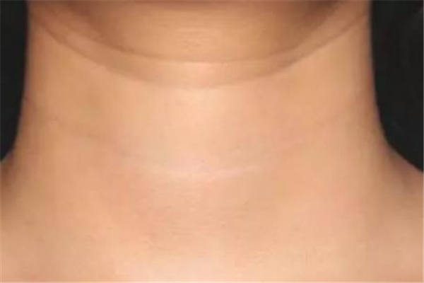 颈纹可以永久去除吗，颈纹可以打玻尿酸吗